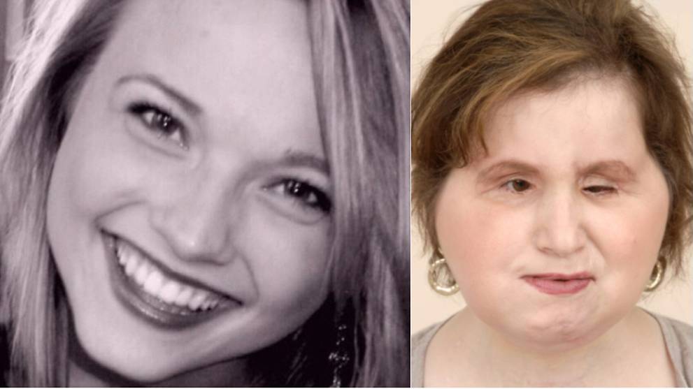 US woman who shot herself receives face transplant CNA