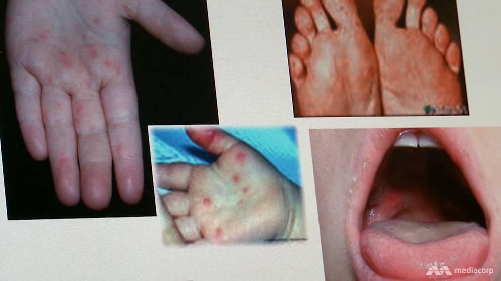 7 things to know about the more virulent strain of HFMD that’s killed 2
