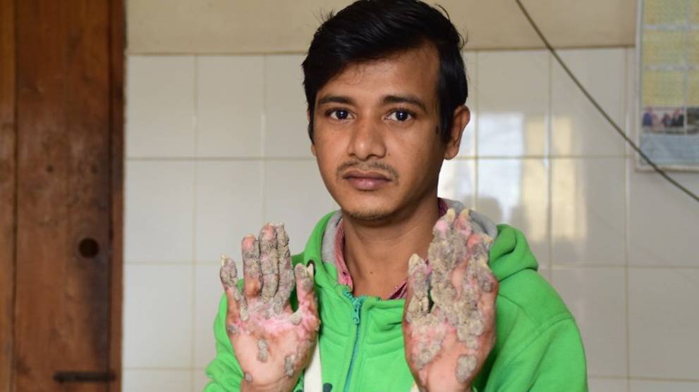 Bangladesh Tree Man Wants Hands Amputated To Relieve Pain Cna