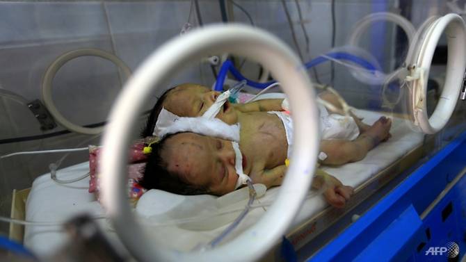the-twin-boys-shared-a-kidney-and-a-pair-of-legs-but-hadseparate-hearts-and-lungs-1549778640680-2.jpg