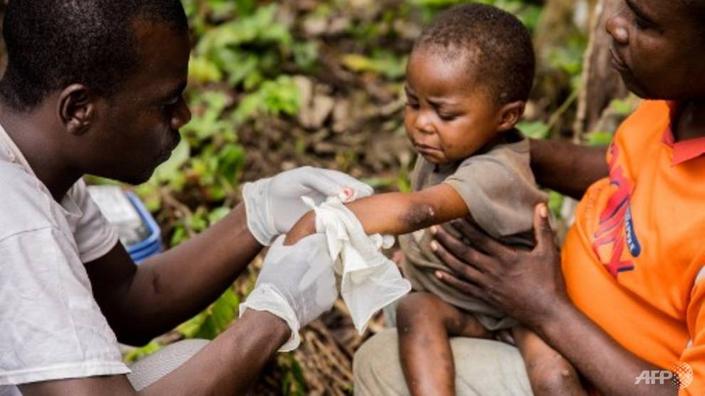 First Monkeypox Case In Singapore What You Need To Know About The Disease Cna