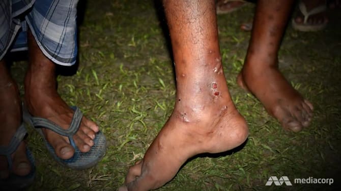 Leeches stuck to 15-year-old Hafizur Rahman while he worked in a quarry in Arunachal Pradesh.