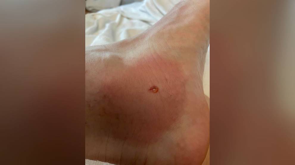 Man stung by stingray at Tanjong Beach in Sentosa - Vimarsana News