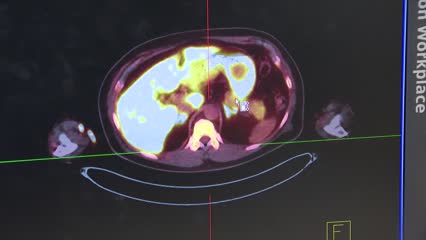 New imaging technique to diagnose hypertension | Video